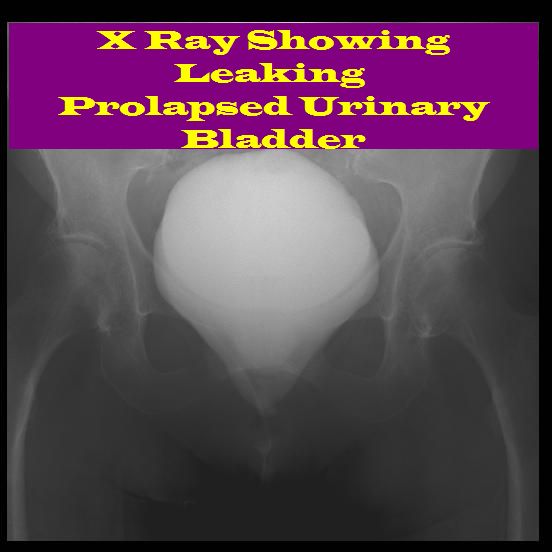 Bladder Prolapse Stress Incontinence Serag Youssif Bladder Prolapse Stress Incontinence Serag Youssif